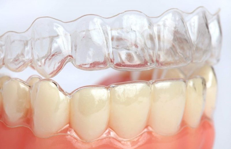 Элайнеры Invisalign в Алматы: Современное решение для исправления зубов